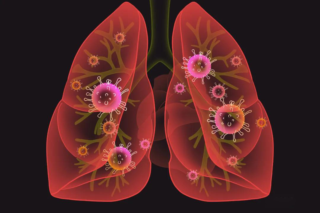 全球面临新一轮癌症大爆发，看看你是否为易癌体质