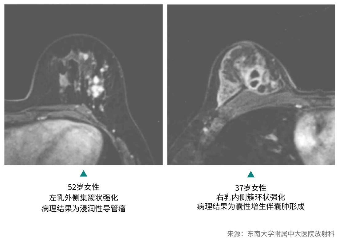 乳腺MRI检查的重要性和检前注意事项